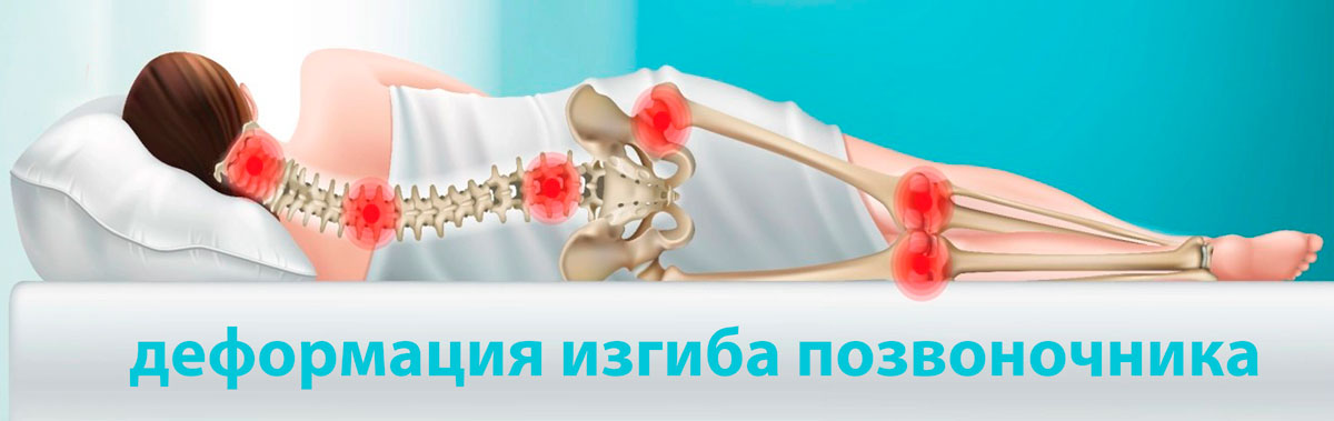 Деформация изгиба позвоночника Деформация изгиба позвоночника
